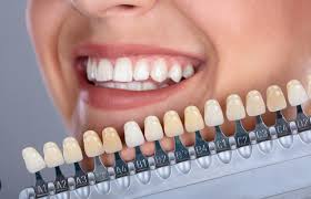 Memahami Perbedaan Pilihan Estetika Gigi