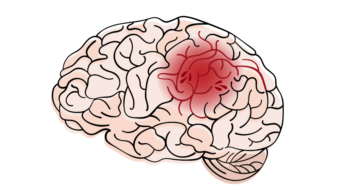 All the courses with our parter website are developed by nurses and other healthcare professionals and are accredited . Stroke For Aprns Nursing Ce Course Nursingce