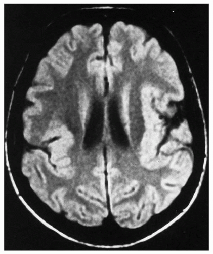 Malformations of Cortical Development and Epilepsy | Neupsy Key