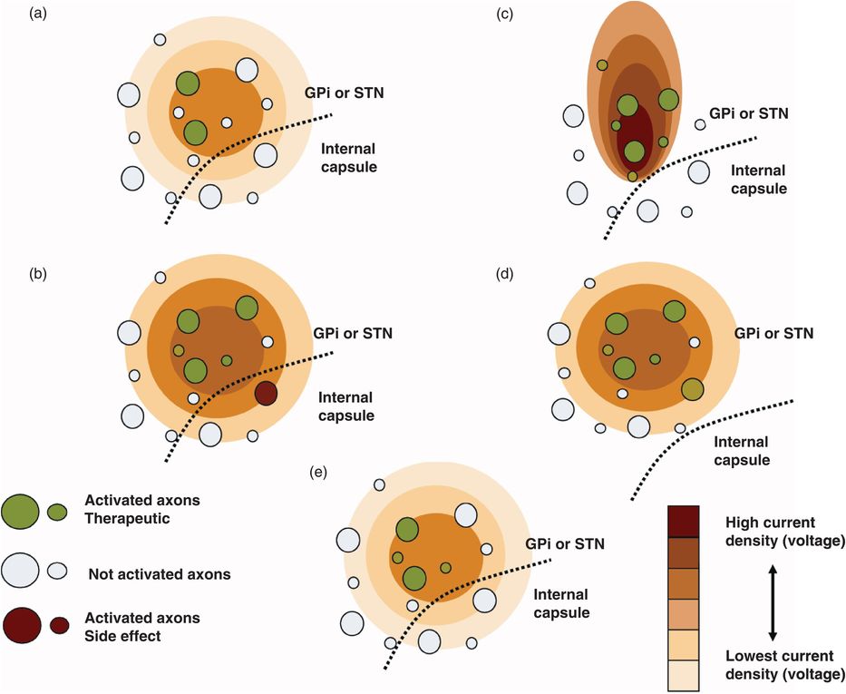Principles of neurostimulation Neupsy Key