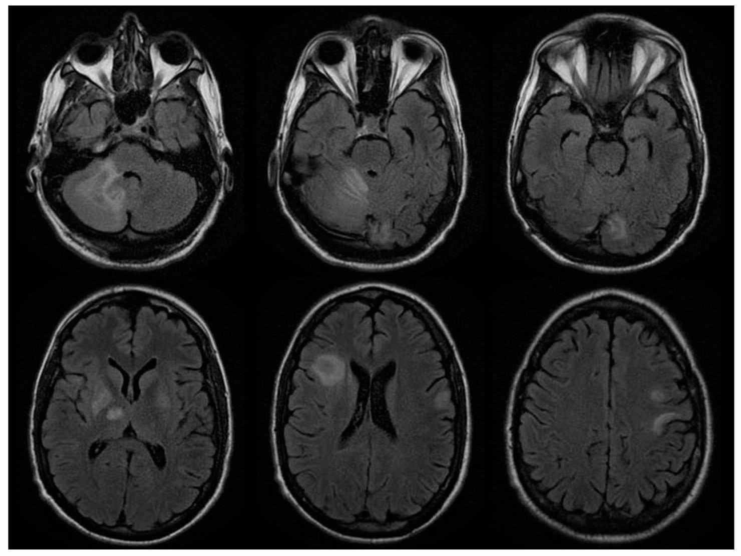Neurologic Complications in Acquired Immune Deficiency Syndrome