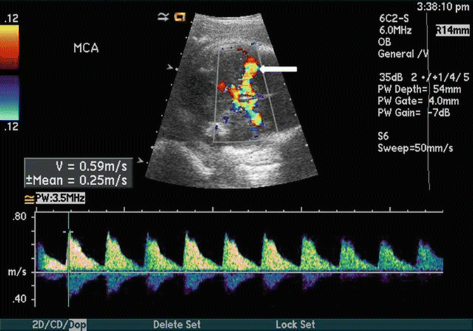Imaging of the Fetal Brain and Spine | Neupsy Key