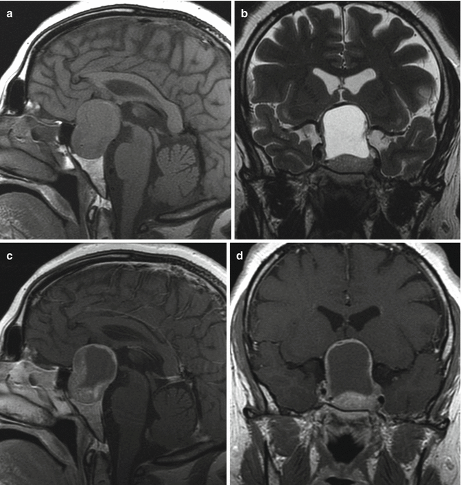 Endoscopic Endonasal Transsphenoidal Approach Neupsy Key