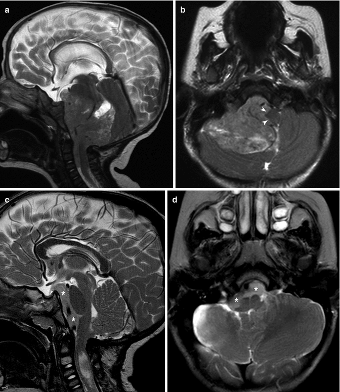 Neuroimaging of Posterior Fossa Ependymoma in Children | Neupsy Key