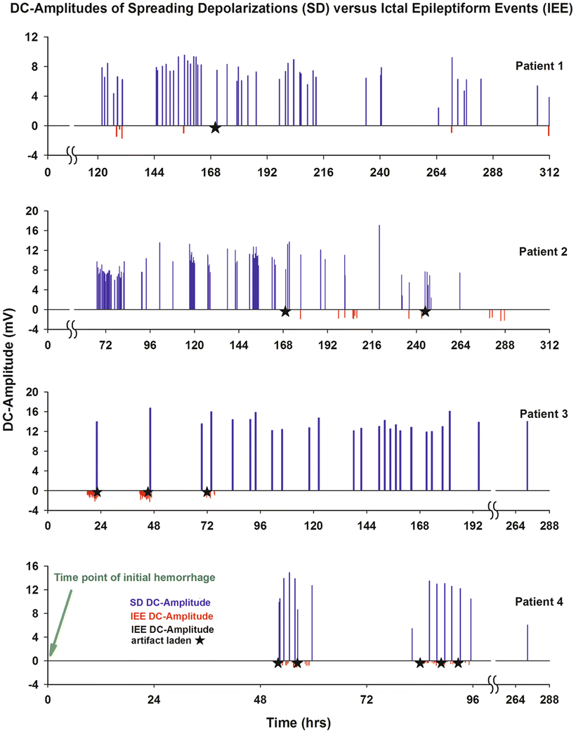 Spreading Depolarizations and Seizures in Clinical Subdural
