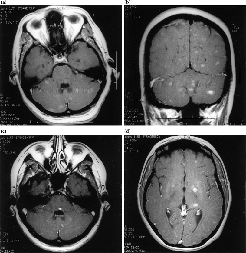 Neurologic Complications of Hematopoietic Stem Cell Transplantation ...