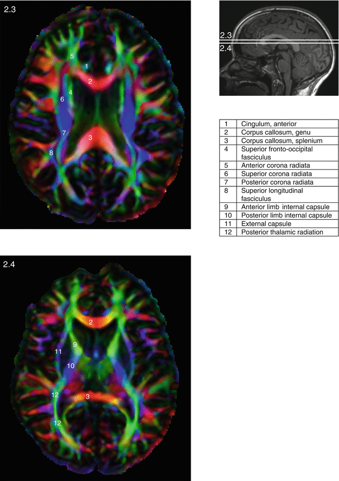 White Matter Anatomy Neupsy Key