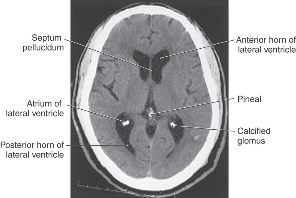 The Ventricles, Choroid Plexus, and Cerebrospinal Fluid Neupsy Key