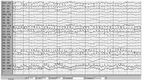 Neonatal and Pediatric Epilepsy Syndromes | Neupsy Key