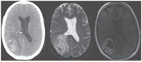 Stroke, Epilepsy, Sleep disorders, Coma, and Migraine | Neupsy Key