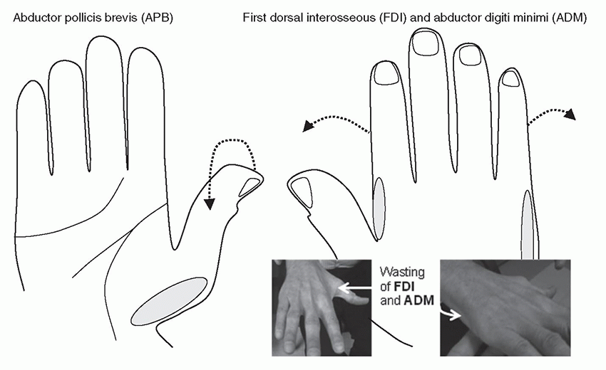 Neuromuscular Disorders | Neupsy Key