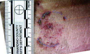 26. Bite Mark Injuries | Nurse Key