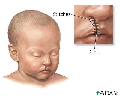 You can also use water alone or give . Cleft Lip And Palate Nursing Crib