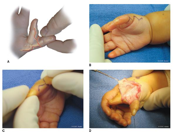 Tendons are thick, fibrous cords tha. Preaxial Polydactyly | Obgyn Key