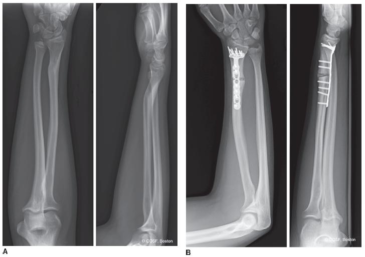 Forearm Fractures Obgyn Key