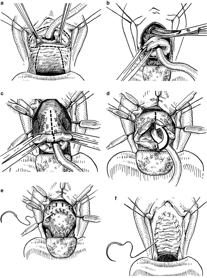 Transvaginal Closure of Bladder Neck Obgyn Key