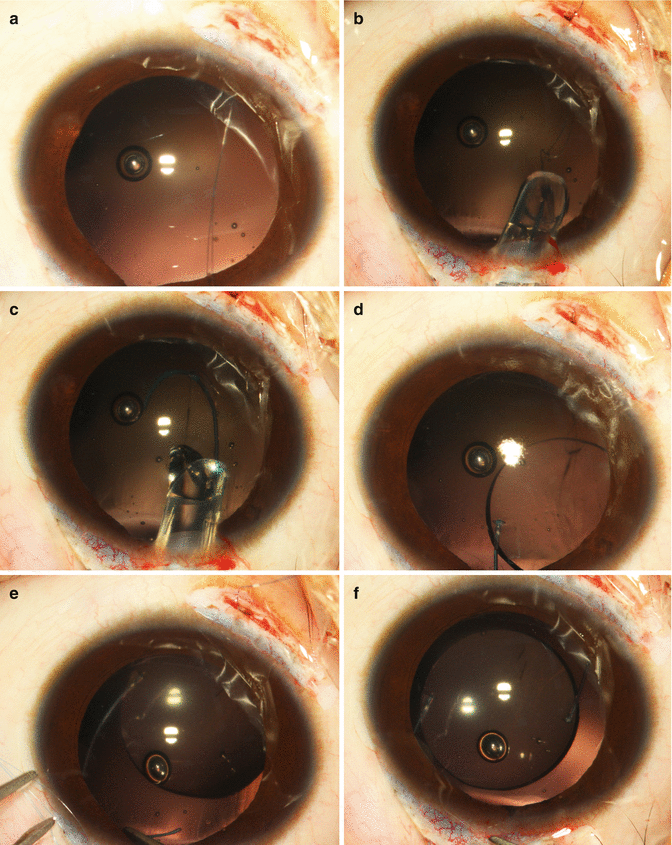 Pediatric Intraocular Lens Implantation Obgyn Key