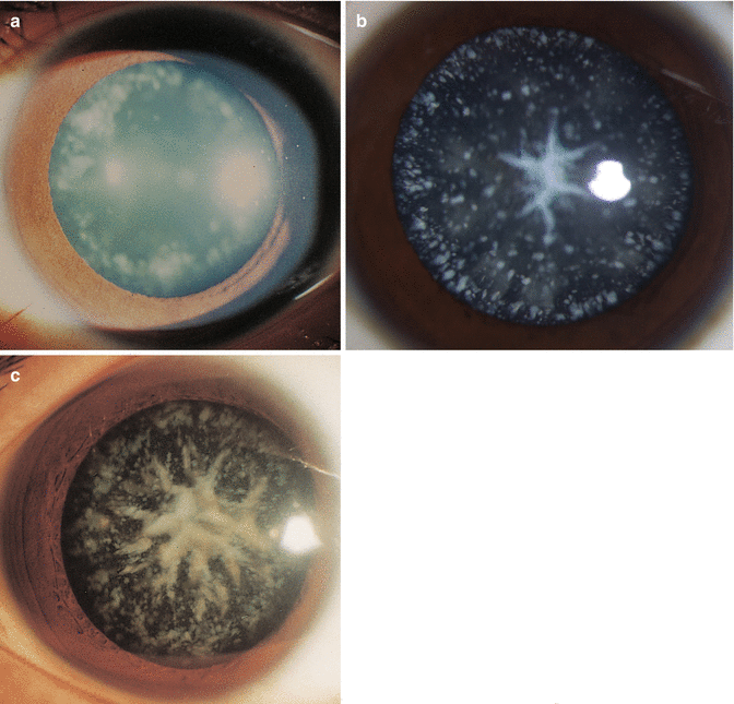 Classification and Morphology of Pediatric Cataracts Obgyn Key