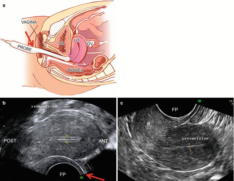 General Techniques in Gynecological Ultrasound Obgyn Key