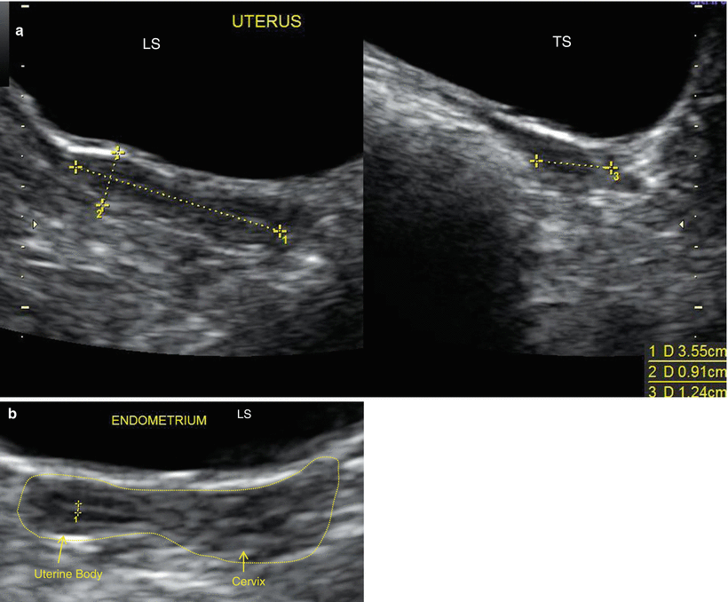 Ultrasound Evaluation Of Myometrium Obgyn Key