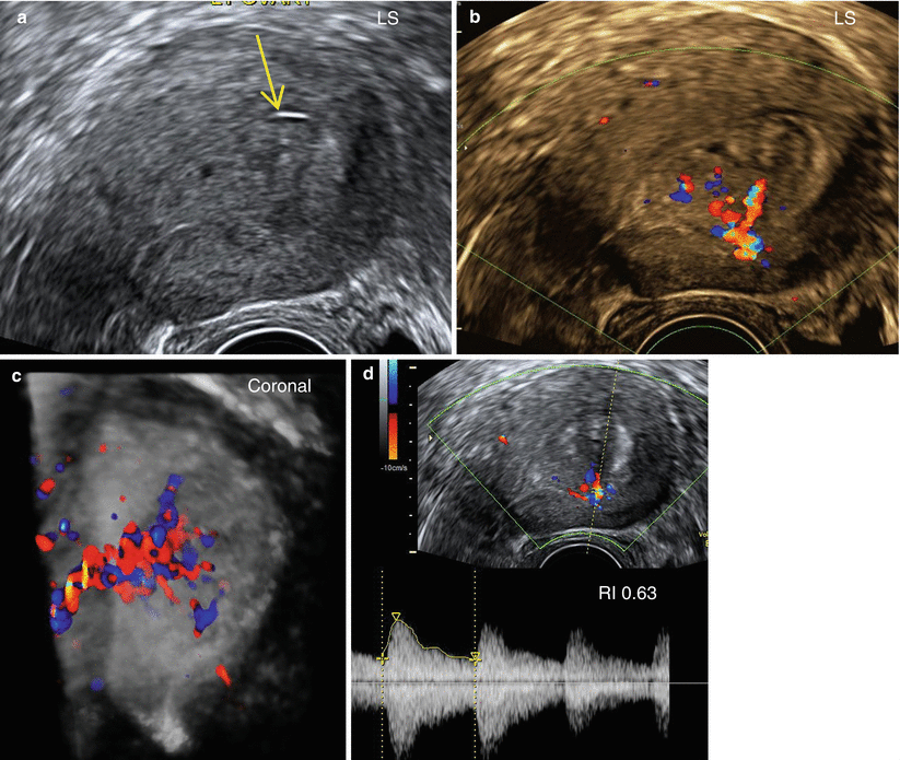 Ultrasound Evaluation of Endometrium Obgyn Key