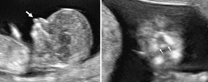Evaluation of the Fetal Face in the First Trimester | Obgyn Key