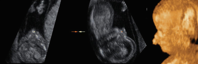 Evaluation of the Fetal Face in the First Trimester | Obgyn Key