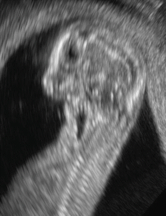 Evaluation of the Fetal Face in the First Trimester | Obgyn Key