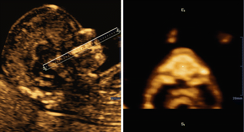 Evaluation of the Fetal Face in the First Trimester | Obgyn Key