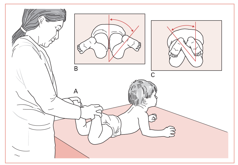 In-toeing and Out-toeing: Rotational Problems of the Lower Extremity ...
