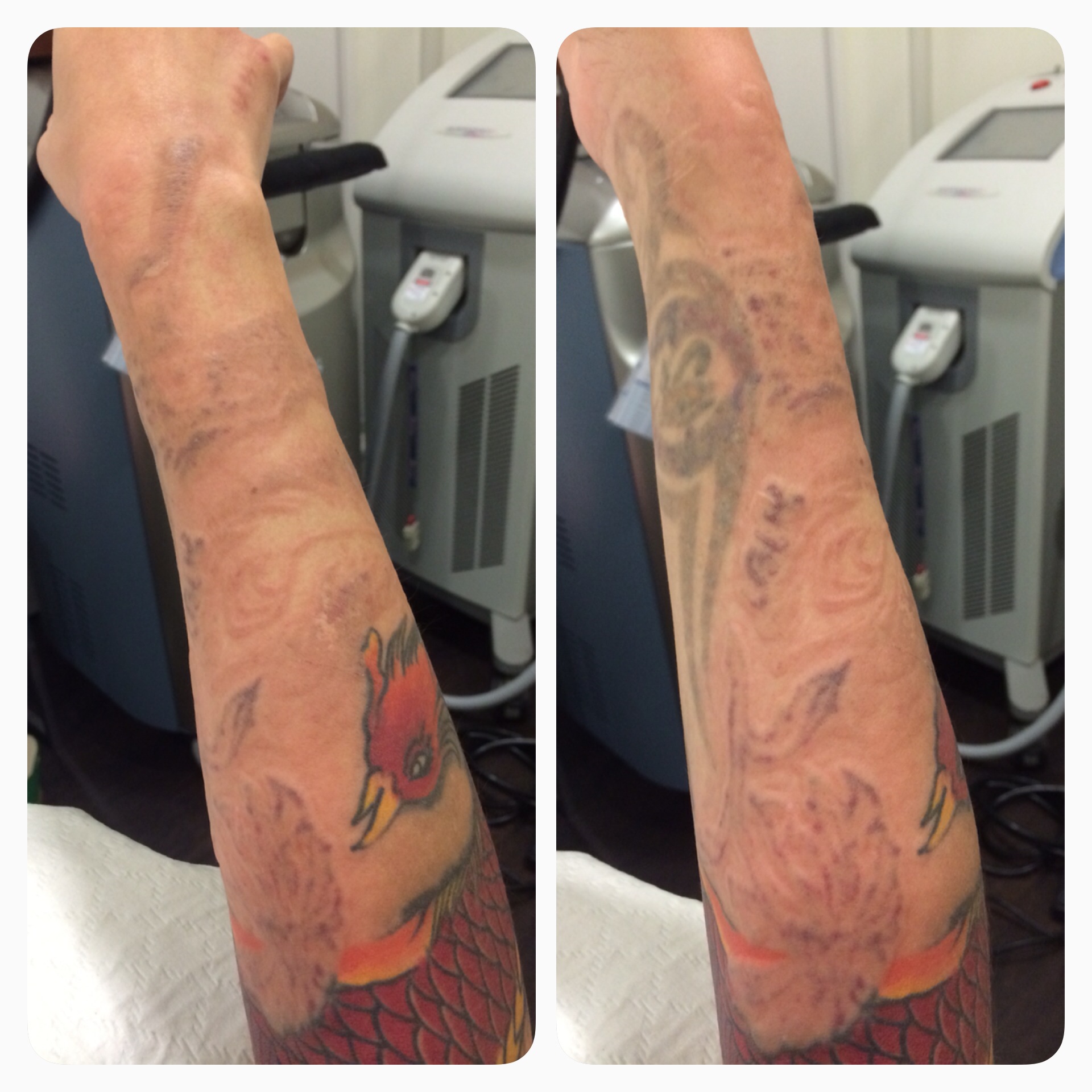Many americans choose to have tatt Tracking Maia Lee S Laser Tattoo Removal Journey At Eha Clinic Aesthetic Surgical Http Www Eha Com Sg
