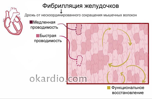 Лечение фибрилляции желудочков. Фибрилляция желудочков неотложная помощь Фибрилляция и трепетание желудочков