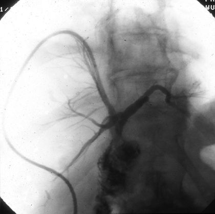 Bile Leak and Bile Duct Injury | Oncohema Key