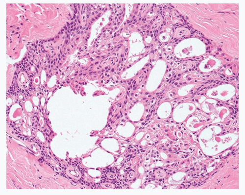 Adenosquamous Carcinoma | Oncohema Key