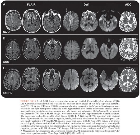 Human Prion Diseases Oncohema Key