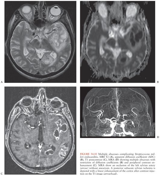 Complications Of Infective Endocarditis Oncohema Key