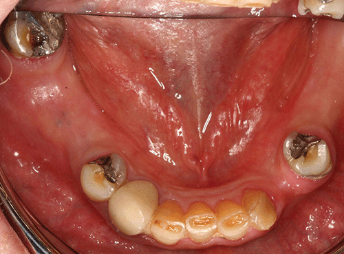 Free Dental Consultation Dental Braces Frenectomy Tooth Extraction And Implants Ask A Dentist Free Dental Consultation Dental Braces Frenectomy Tooth Extraction And Implants Ask A Dentist