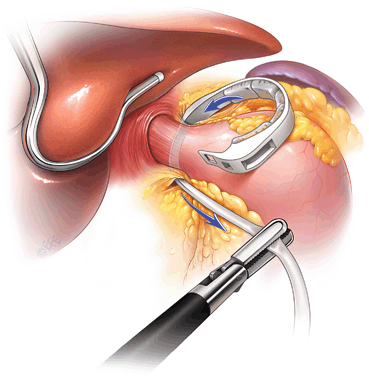 Laparoscopic Adjustable Gastric Banding: Procedure and Outcomes | Oncohema Key
