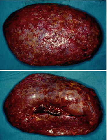 The Spleen and Sickle Cell Anemia | Oncohema Key