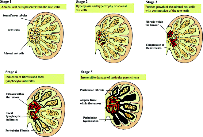 Hypogonadism In Males With Congenital Adrenal Hyperplasia Oncohema Key