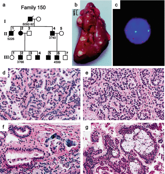 Hereditary Renal Cell Carcinoma Oncohema Key