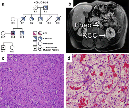 Hereditary Renal Cell Carcinoma | Oncohema Key