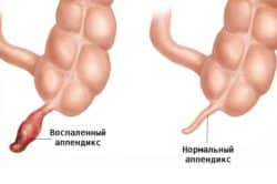 После пьянки болит левый бок