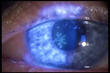 They also claim to add additional vibrancy to the colors that people . KERATITIS | Optometry Today
