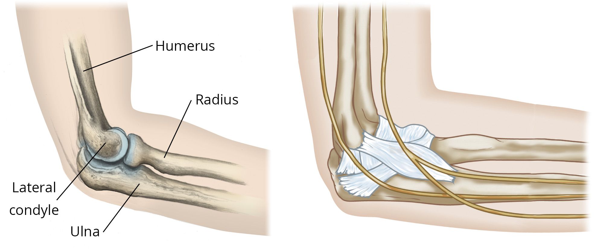 The long head, lateral head, and medial head. Elbow Fractures In Children Orthoinfo Aaos