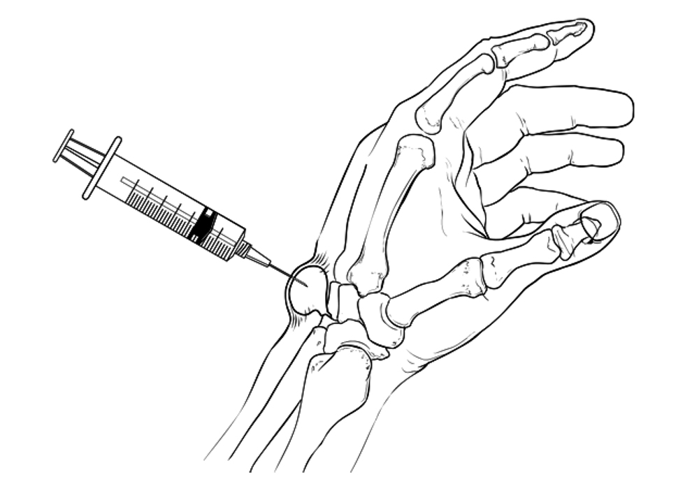 While it usually doesn't cause any symptoms, some people notice pain and a decreased . Ganglion Cyst Of The Wrist And Hand Orthoinfo Aaos