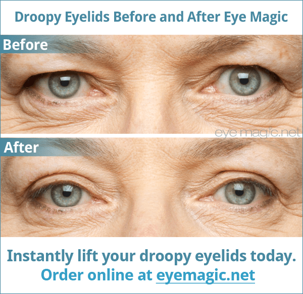 Eye Magic Eye Lift On Twitter The Amazing Before And After Results Of Eye Magic Http T Co Pm5ihe9q4a
