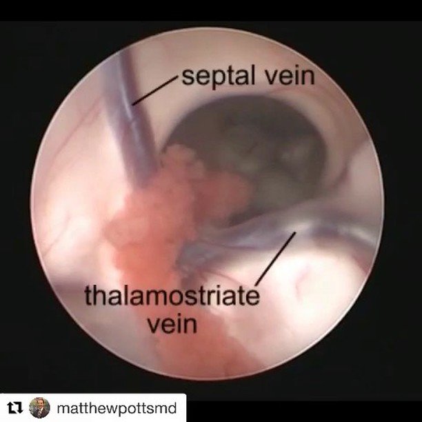 During endonasal endoscopic anterior skull base surgery, the area between the anterior border of the sphenoid sinus and pea artery was safe as the first . Julio Pereira Neurocirurgiao En Twitter Endoscopic Anatomy Of The Right Foramen Of Monro And Third Ventricle As Seen Prior To Performing A Third Https T Co Tyvdm5cgqh Https T Co Rfanozesh8 Twitter