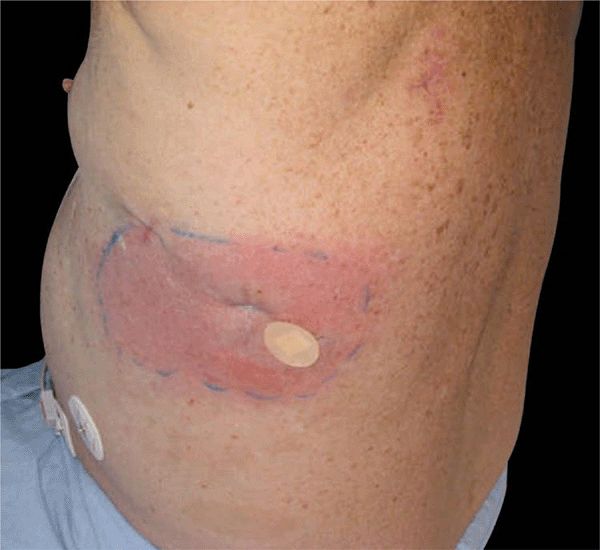 The most common type of kidney cancer is renal cell carcinoma (rcc), accounting for about 90% of all cases. 19 SKIN SIGNS OF SYSTEMIC CANCERS | Plastic Surgery Key