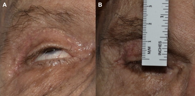 Recognizing and Managing Complications in Blepharoplasty | Plastic ...